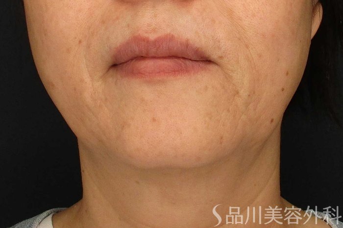 症例NO.65472のBEFORE写真