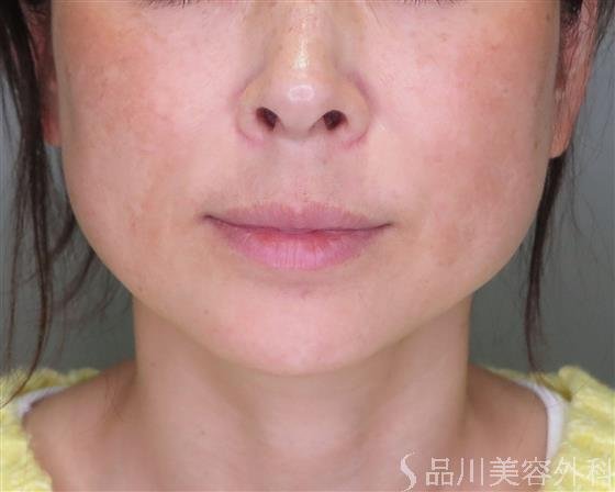 症例NO.49180のBEFORE写真