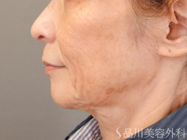 症例NO.75106のBEFORE写真