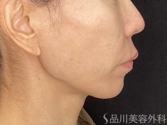 症例NO.72733のAFTER写真