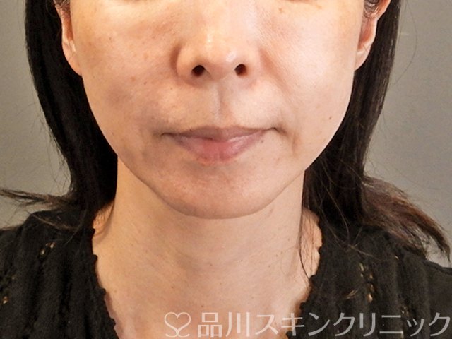 症例NO.66599のAFTER写真
