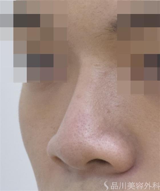 症例NO.48137のAFTER写真