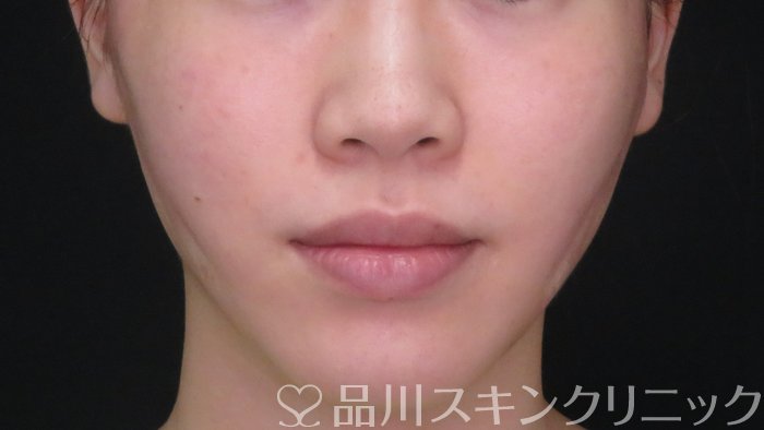 症例NO.71557のAFTER写真