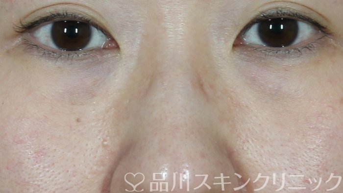 症例NO.71818のBEFORE写真