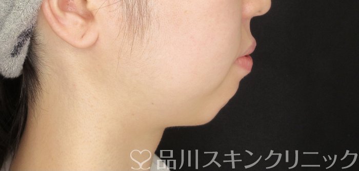 症例NO.69524のBEFORE写真