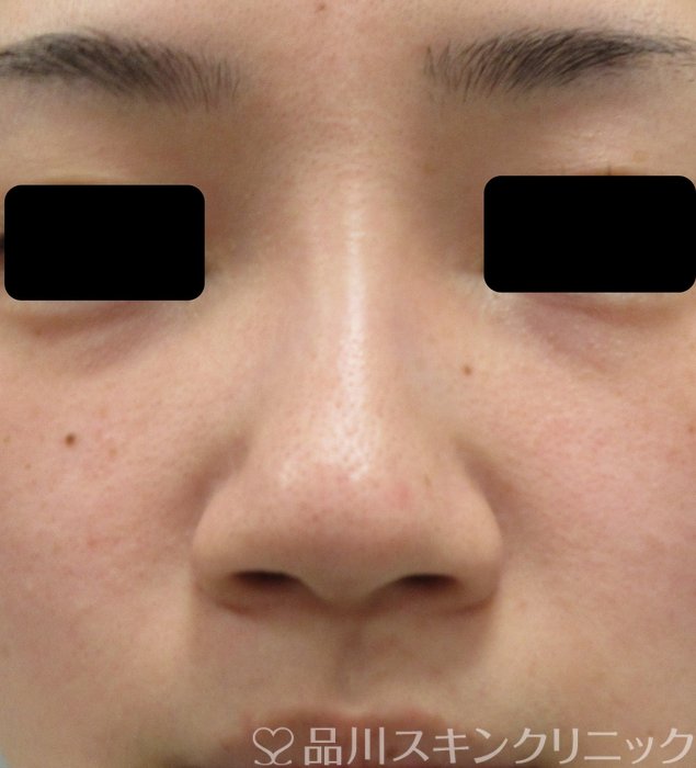 症例NO.72940のBEFORE写真