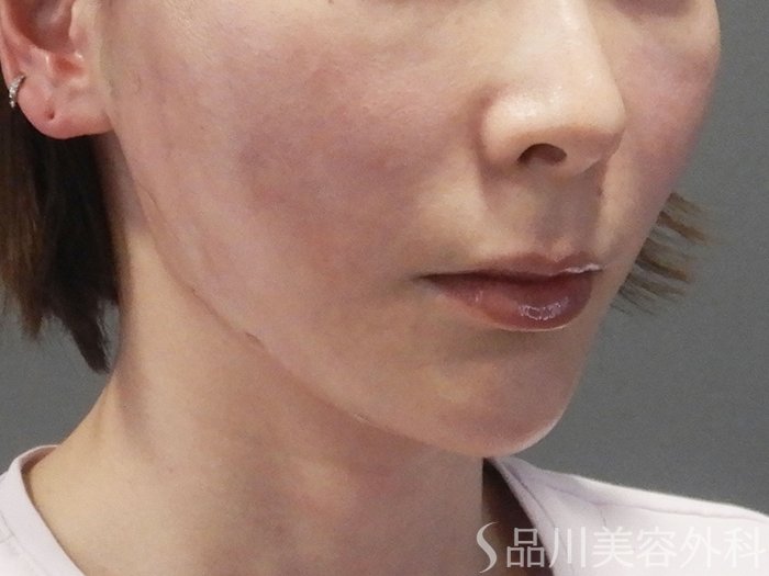 症例NO.70138のAFTER写真