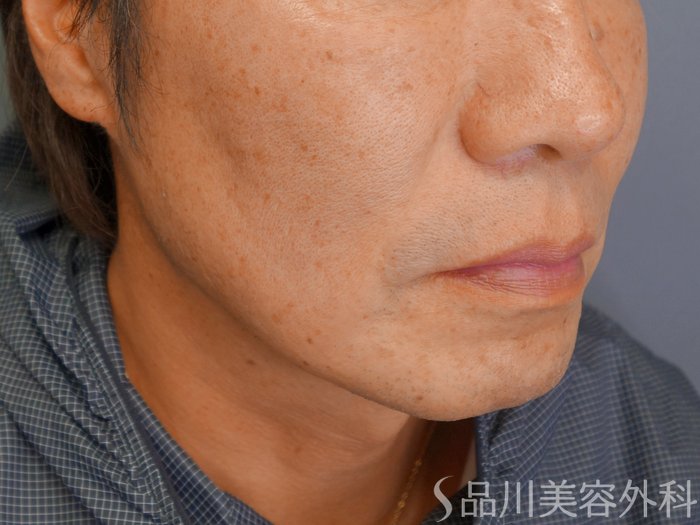 症例NO.70039のBEFORE写真
