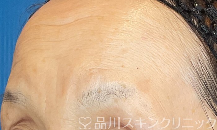症例NO.74752のAFTER写真