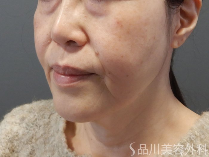 症例NO.70991のBEFORE写真