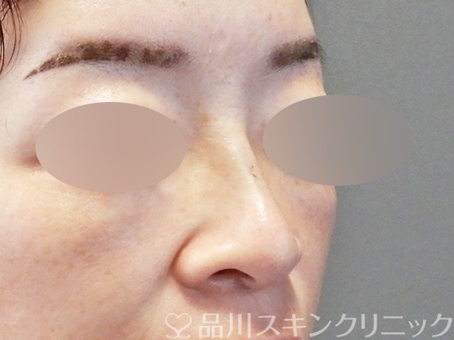 症例NO.66774のAFTER写真