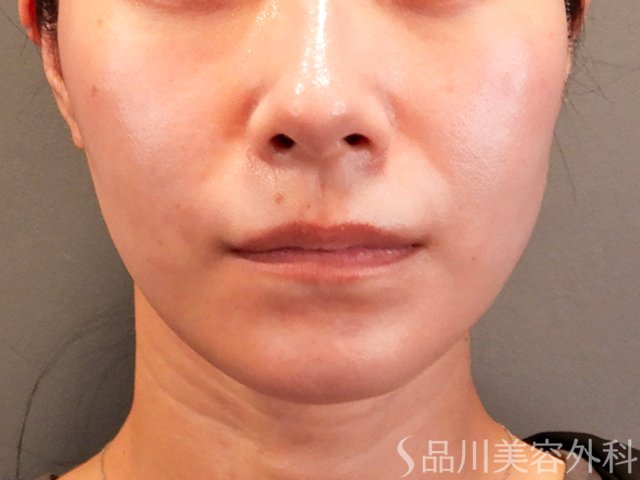症例NO.70322のBEFORE写真