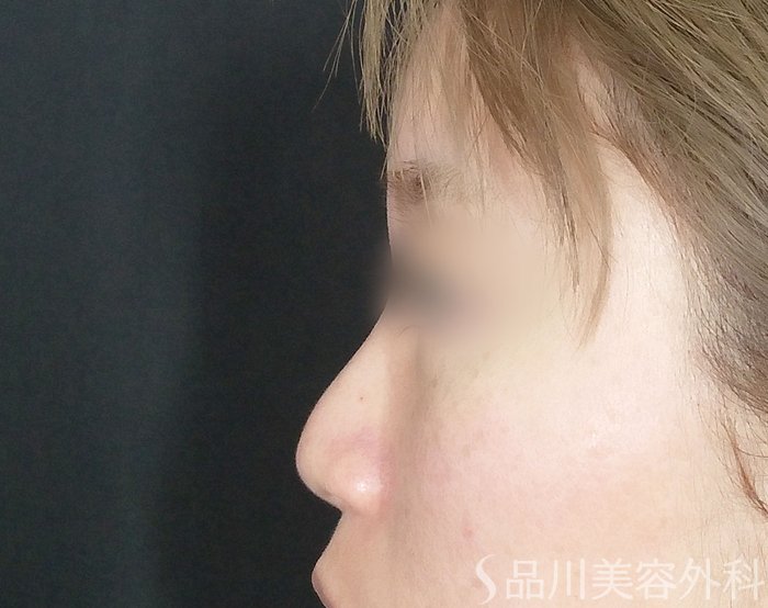 症例NO.62256のBEFORE写真