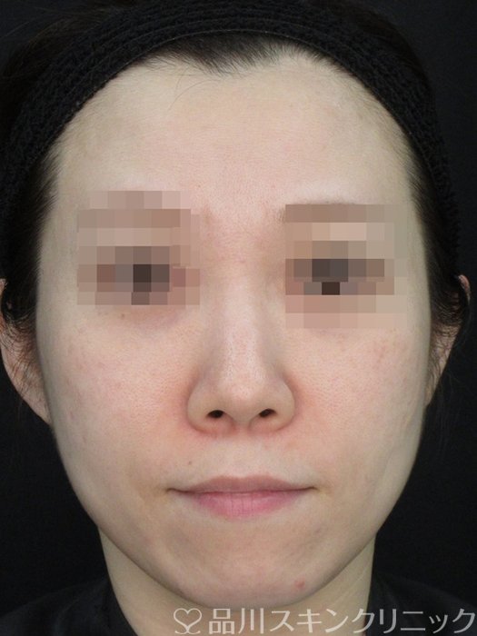 症例NO.73748のAFTER写真