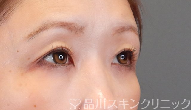 症例NO.75350のAFTER写真