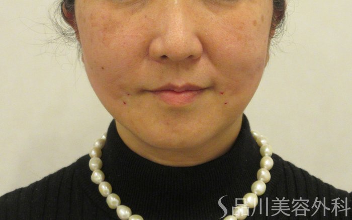 症例NO.72374のAFTER写真