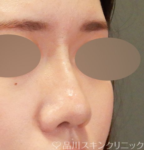 症例NO.64565のAFTER写真