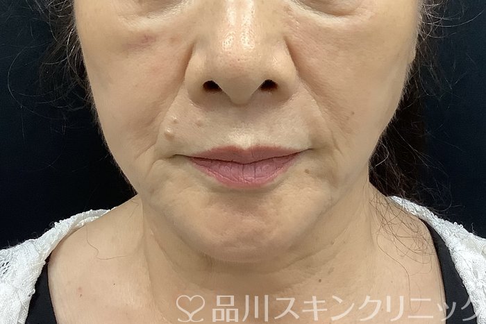 症例NO.69839のBEFORE写真