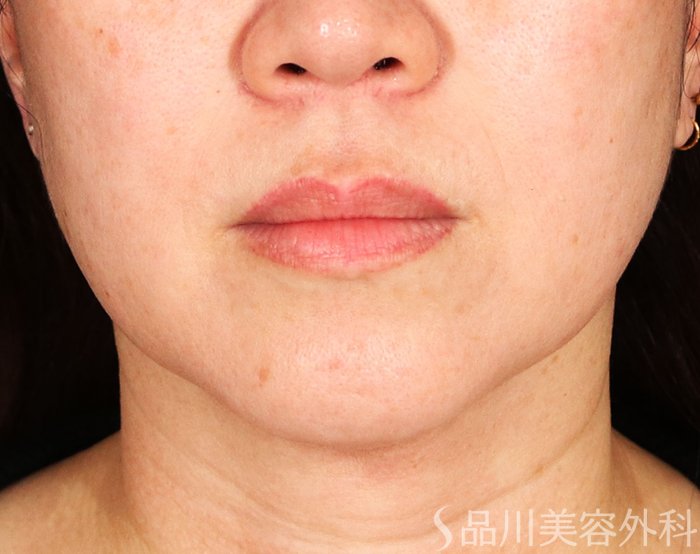 症例NO.73180のBEFORE写真