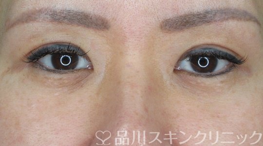 症例NO.69634のAFTER写真