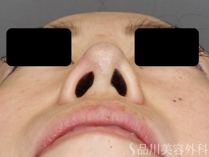 症例NO.72632のAFTER写真