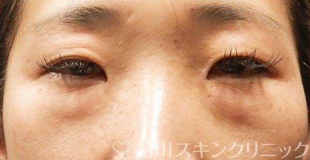 症例NO.64057のBEFORE写真