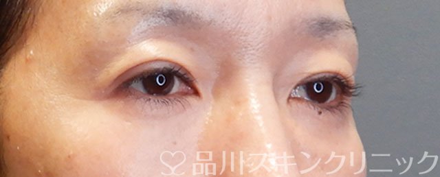 症例NO.75243のAFTER写真