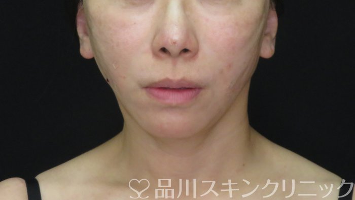 症例NO.72809のAFTER写真