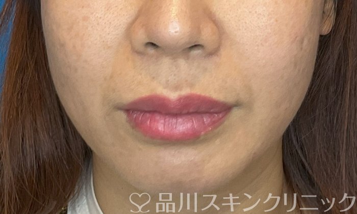 症例NO.74849のAFTER写真