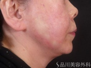 症例NO.73845のAFTER写真