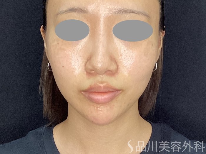 症例NO.71827のAFTER写真