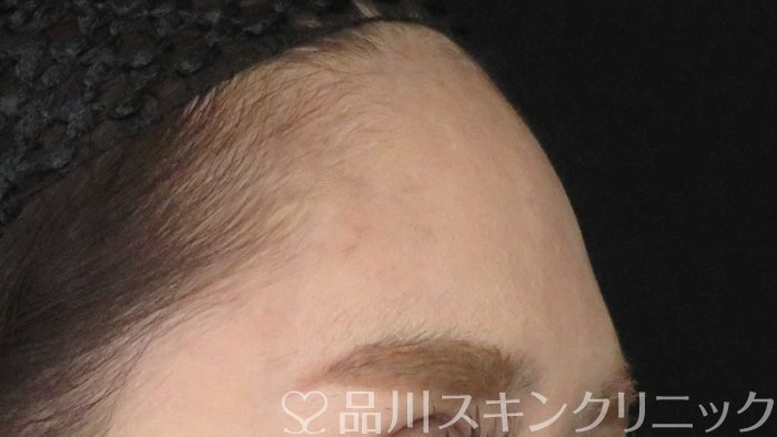 症例NO.71804のBEFORE写真