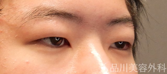 症例NO.72319のBEFORE写真