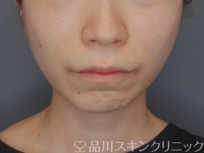 症例NO.72826のAFTER写真