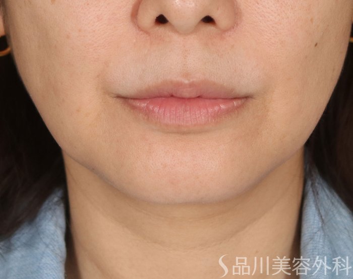 症例NO.74099のBEFORE写真
