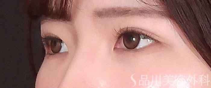 症例NO.70104のAFTER写真