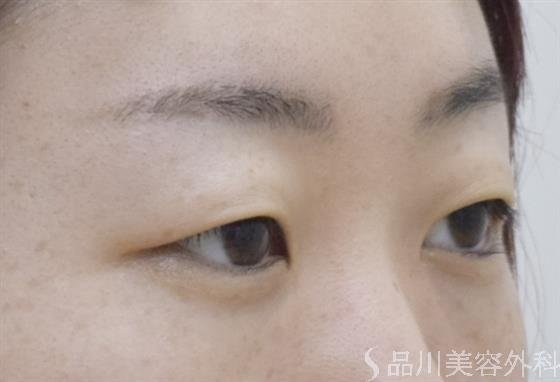 症例NO.54041のBEFORE写真