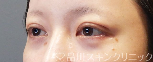 症例NO.74999のAFTER写真