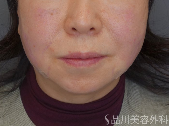 症例NO.72547のAFTER写真