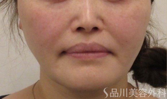 症例NO.75167のBEFORE写真