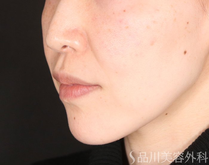 症例NO.73380のBEFORE写真