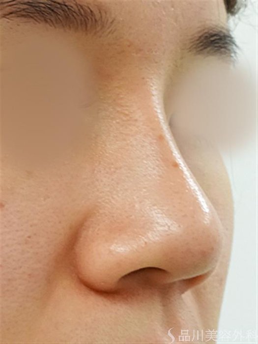 症例NO.30854のAFTER写真