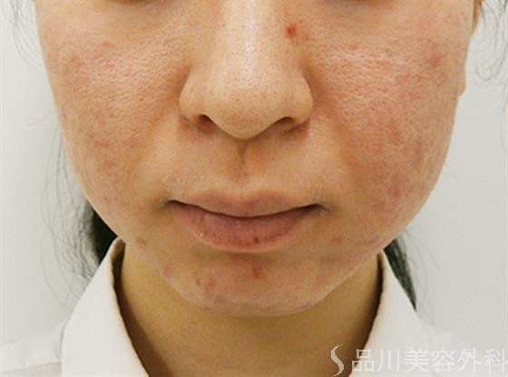 症例NO.40748のBEFORE写真