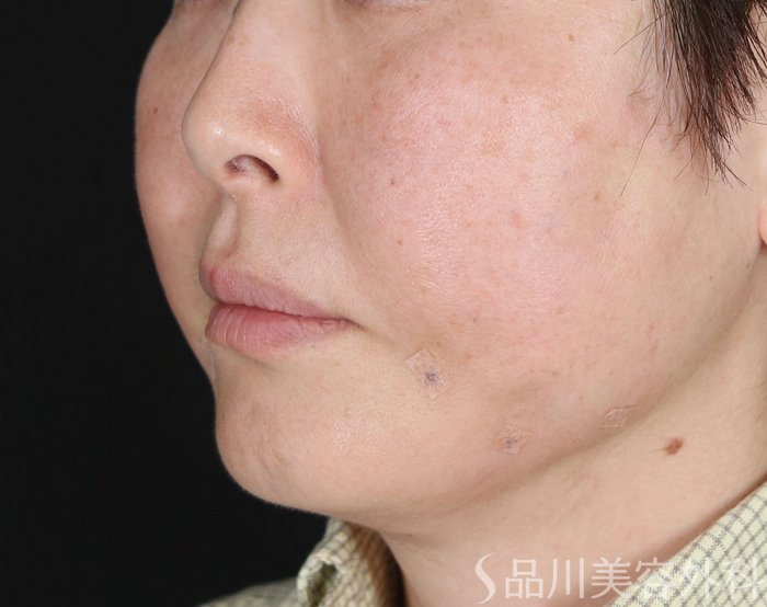 症例NO.72645のAFTER写真