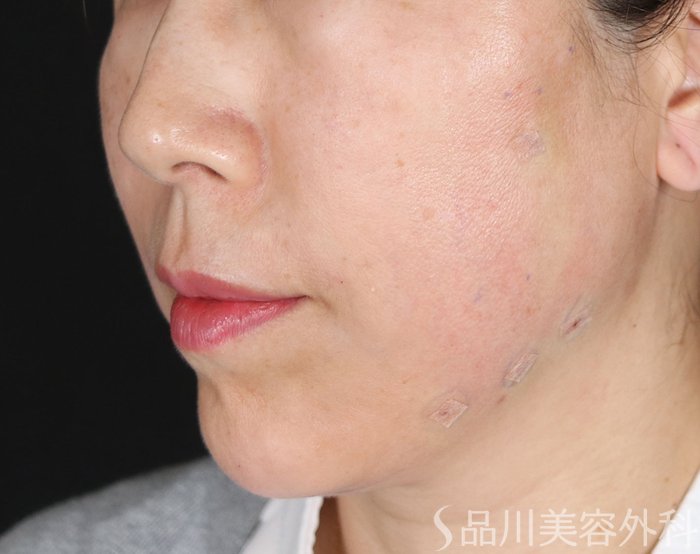 症例NO.72057のAFTER写真