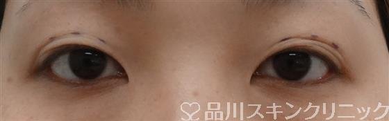 症例NO.30499のBEFORE写真