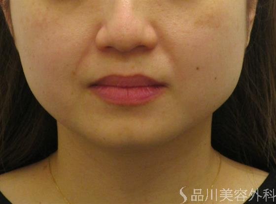症例NO.46403のBEFORE写真