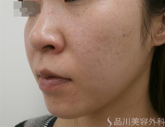 症例NO.26057のBEFORE写真