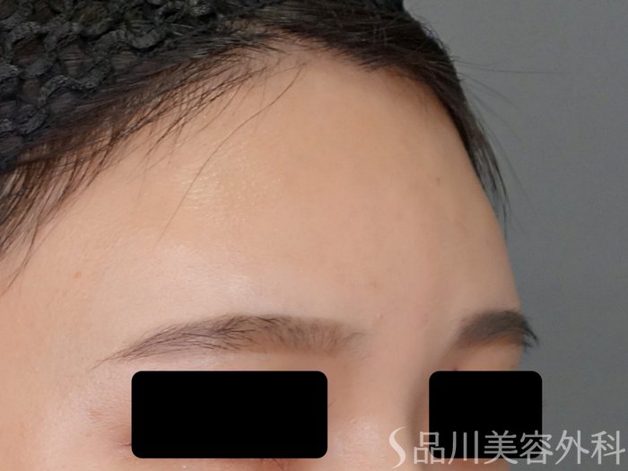 症例NO.69225のBEFORE写真