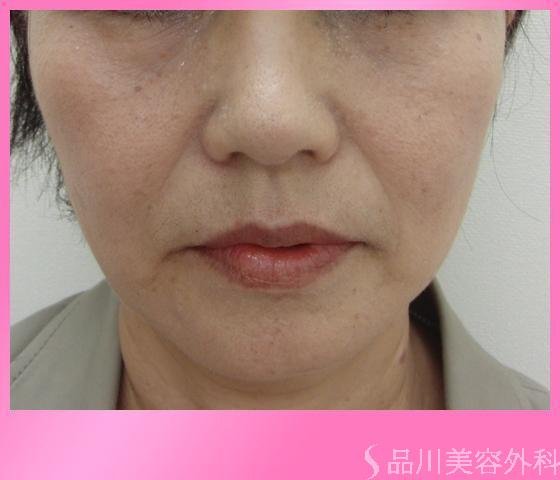 症例NO.3240のAFTER写真